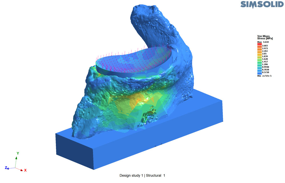 Using Altair SimSolid for bone biomechanics – The University of Western Ontario