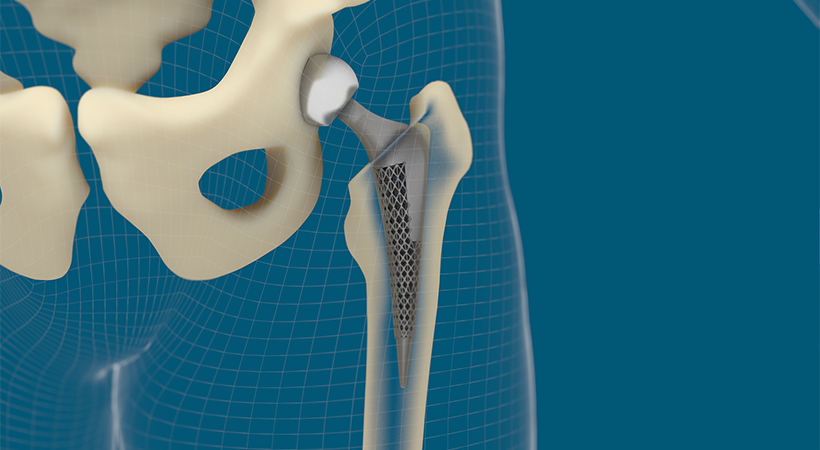 Ensuring Economic Viability for Medical Additive Manufacturing: An Interview with Dave Coates, Altair Chief Engineer