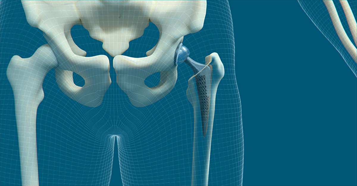 Meshless Analysis Using SimSolid for Biomedical Applications