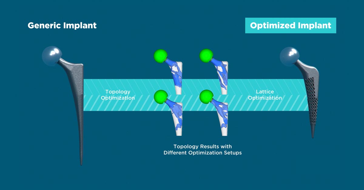 Developing a 3D Printed Solid-Lattice Hip Prosthesis